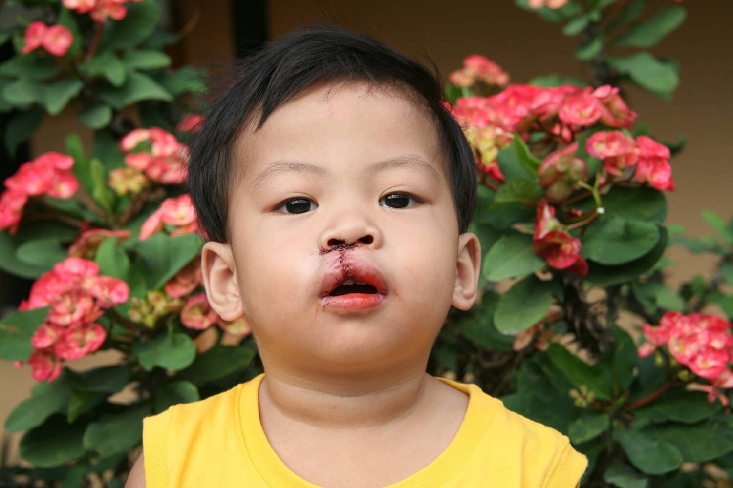 Neponset Valley Oral and Maxillofacial Surgery Associates | Bone Grafting, Facial Trauma and Tooth Extractions