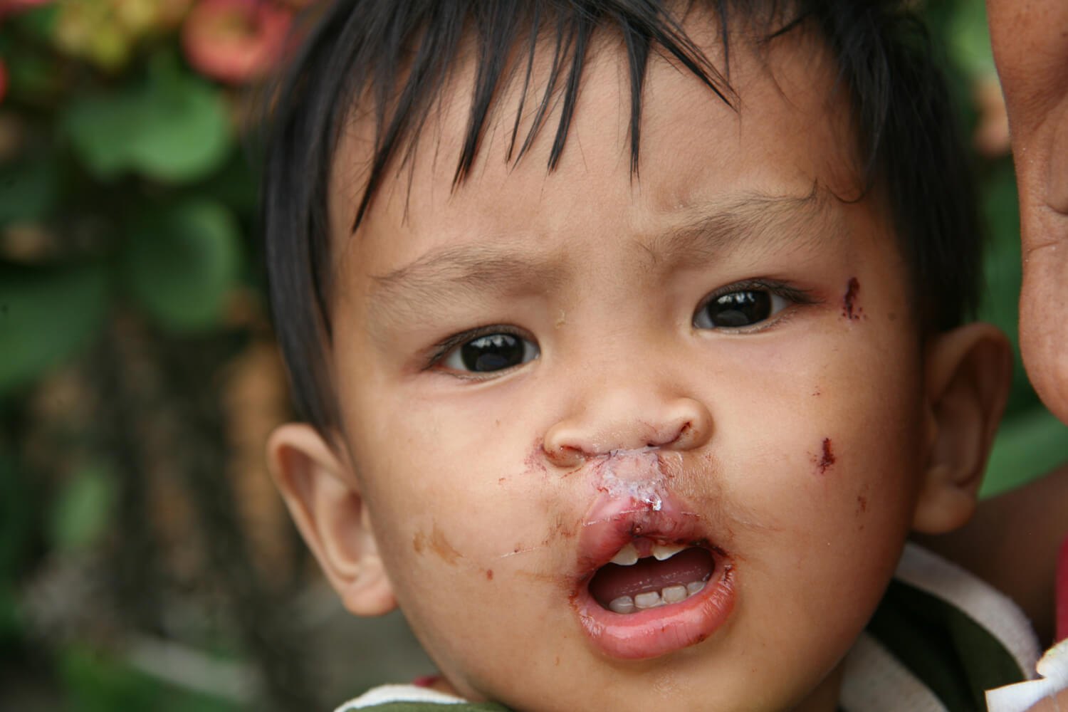 Neponset Valley Oral and Maxillofacial Surgery Associates | Cleft Lip Palate, Dental Implants and Facial Trauma